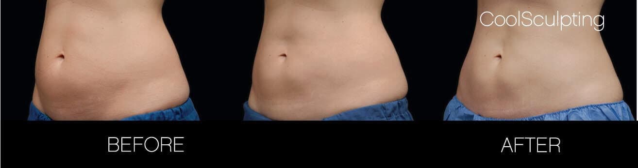 CoolSculpting - Before and After Gallery – Photo 13