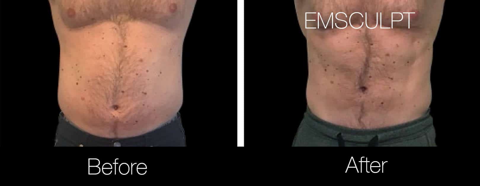 Emsculpt - Before and After Gallery – Photo 13
