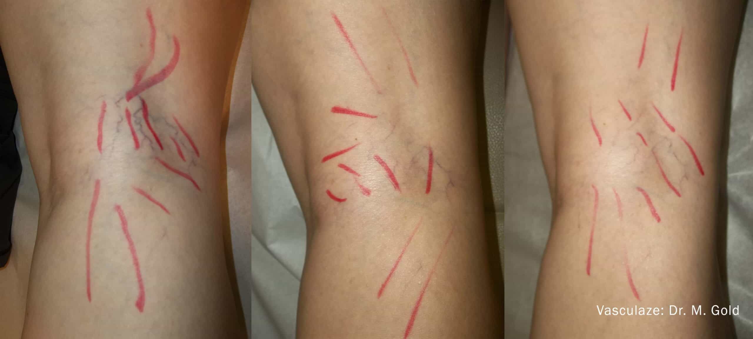 Leg Vein Reduction - Patient Before and After Gallery – Photo 13