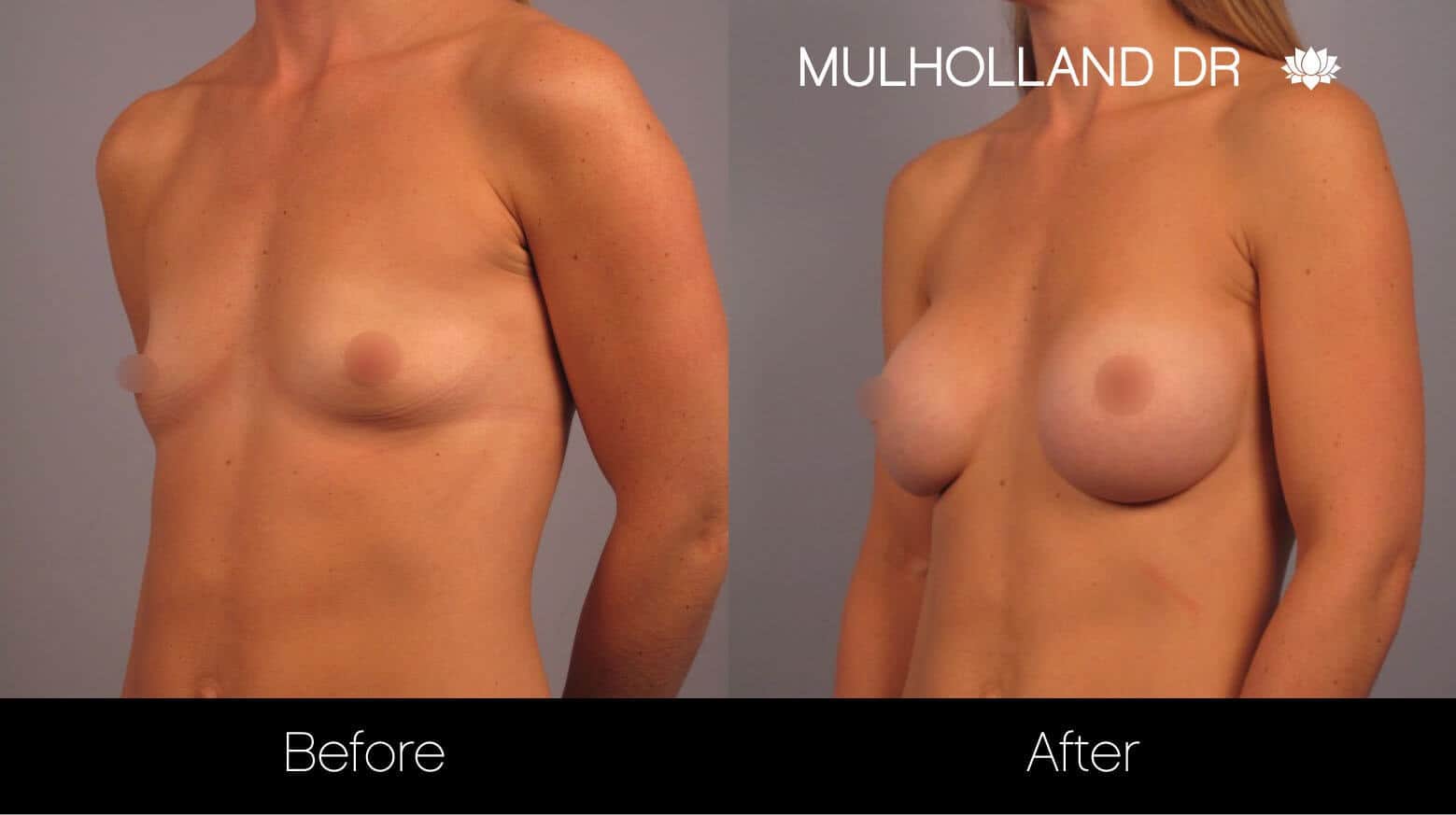 Breast Augmentation - Before and After Gallery – Photo 13