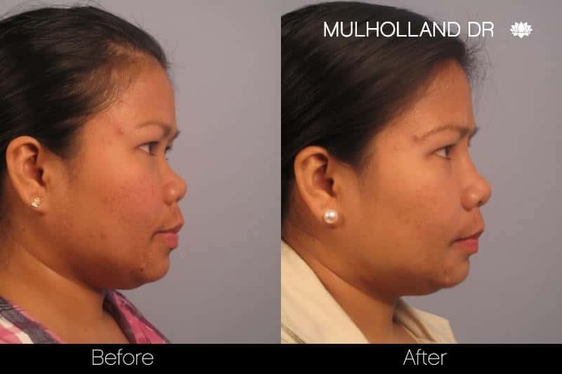 5 Minute Nose Job - Before and After Gallery – Photo 14