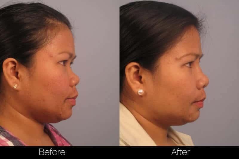 5 Minute Nose Job - Before and After Gallery – Photo 14
