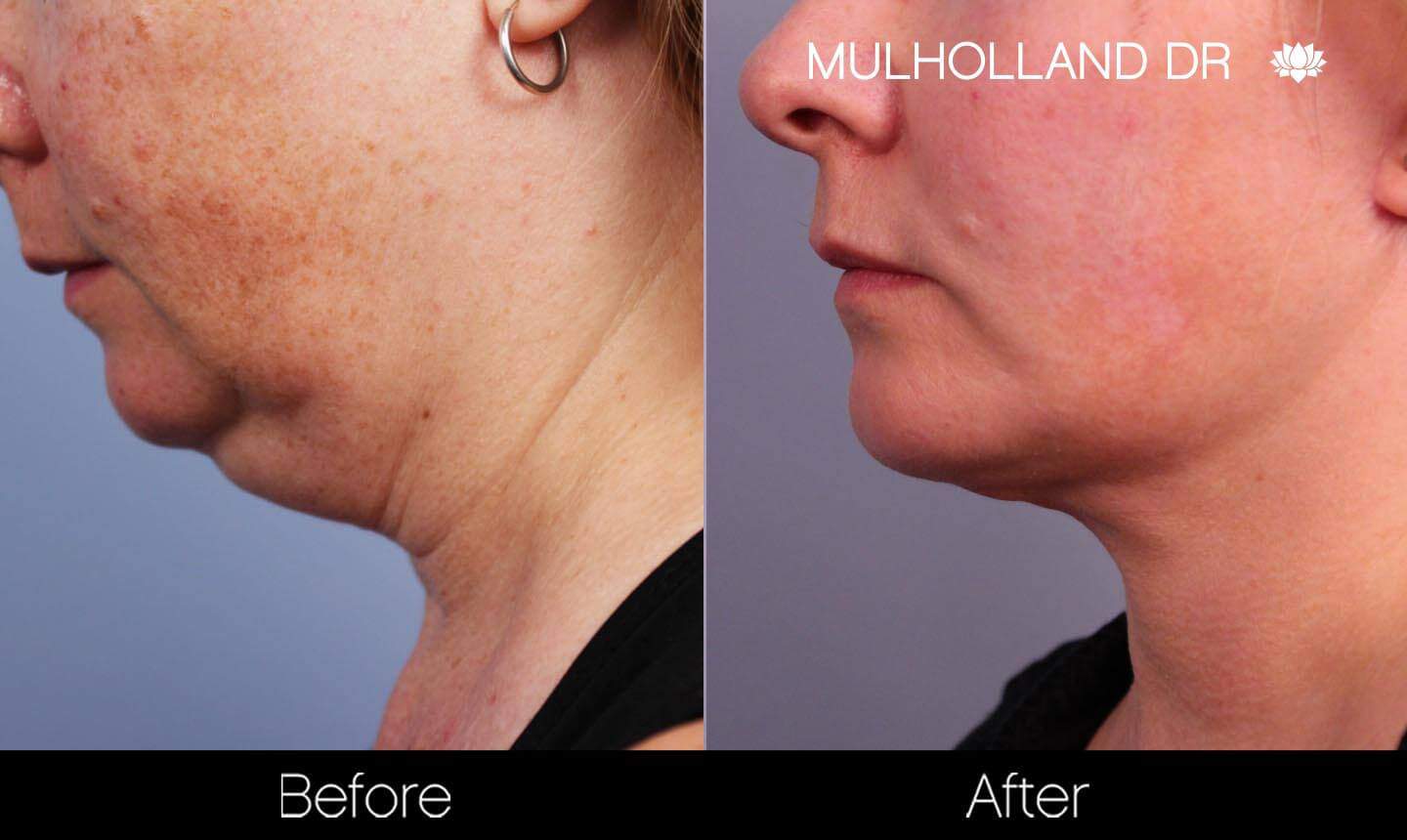 Non-Surgical Facelift - Before and After Gallery – Photo 14