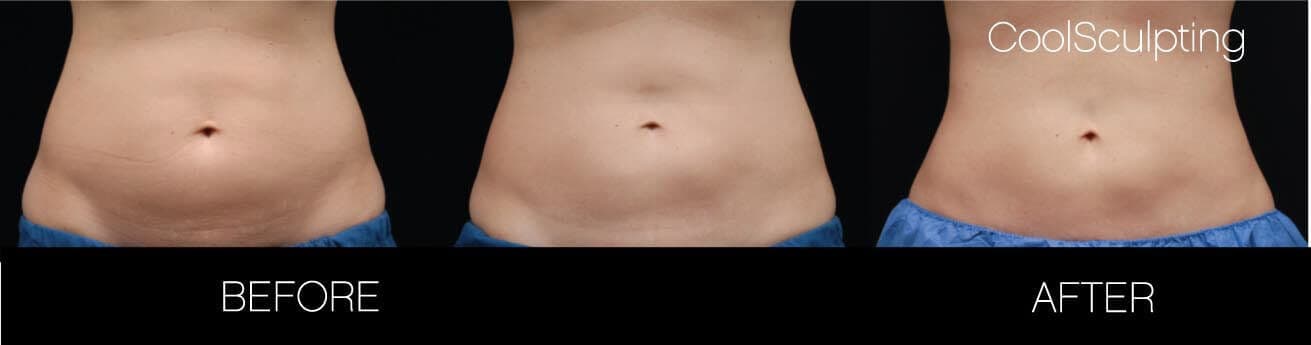 CoolSculpting - Before and After Gallery – Photo 14