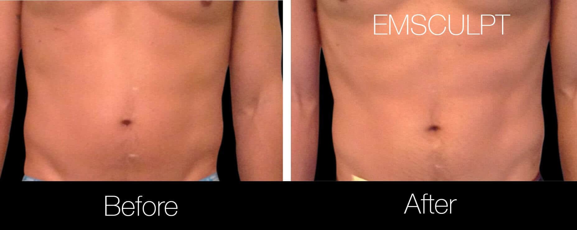 Emsculpt - Before and After Gallery – Photo 14