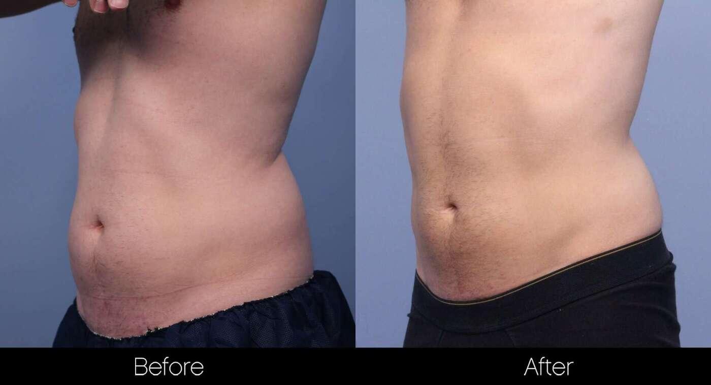 SculpSure - Before and After Gallery – Photo 15