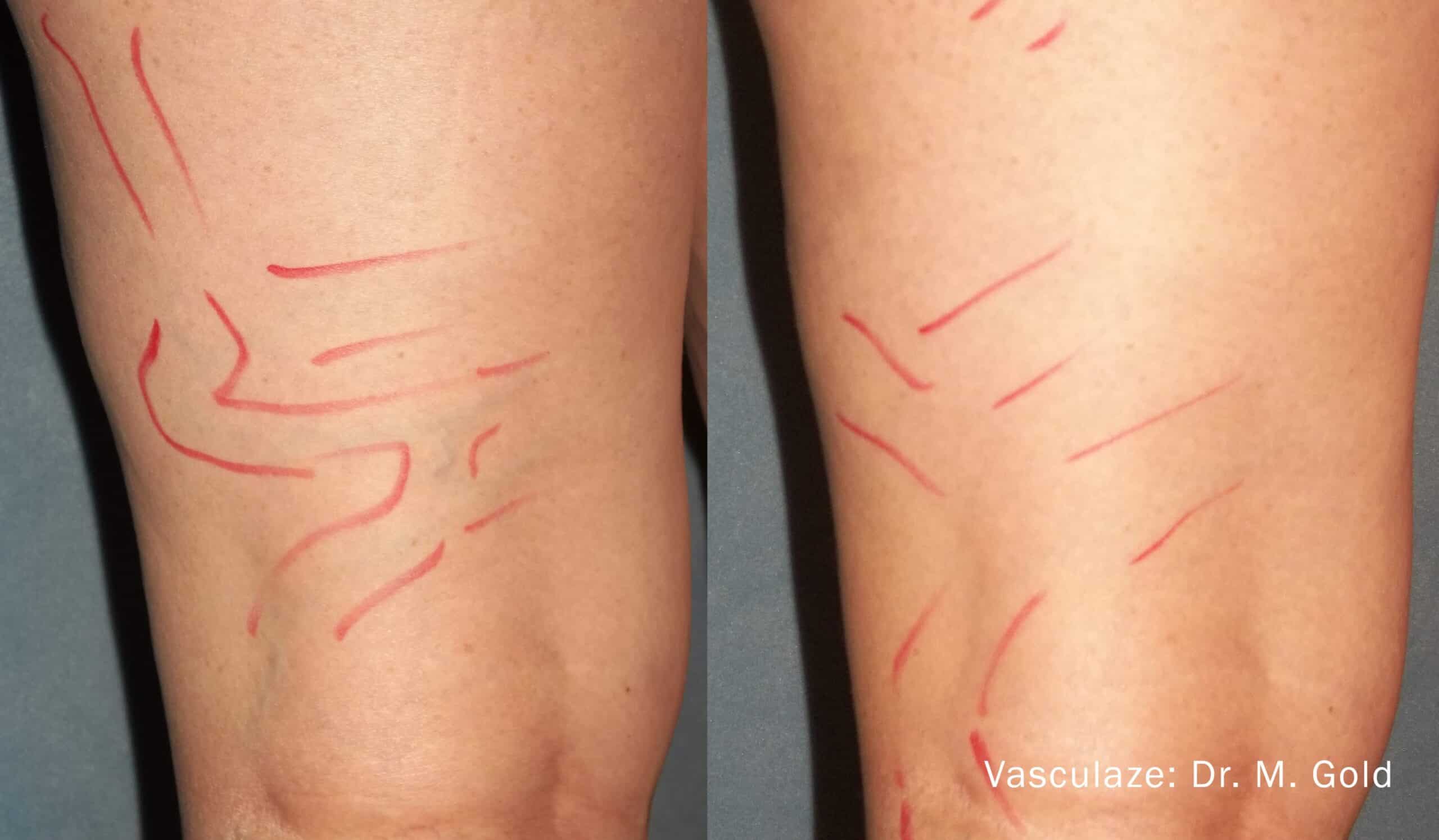 Leg Vein Reduction - Patient Before and After Gallery – Photo 14