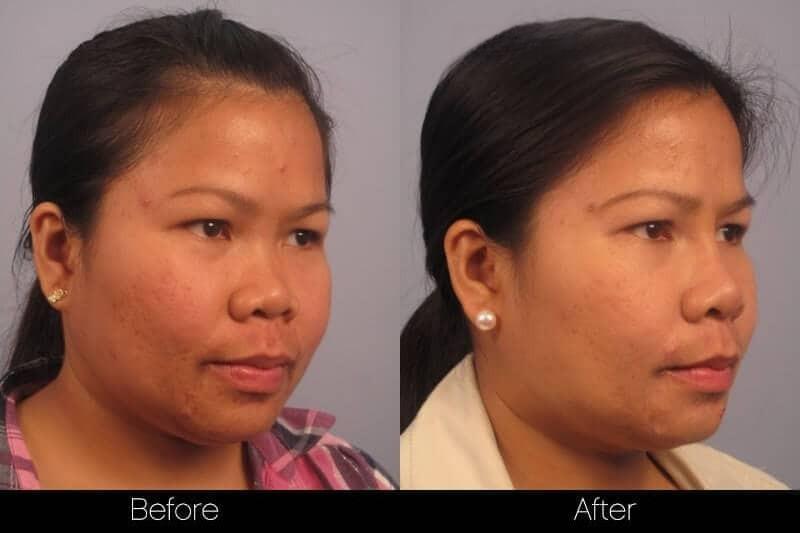 5 Minute Nose Job - Before and After Gallery – Photo 15