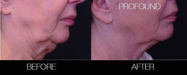 Non-Surgical Facelift - Before and After Gallery – Photo 15