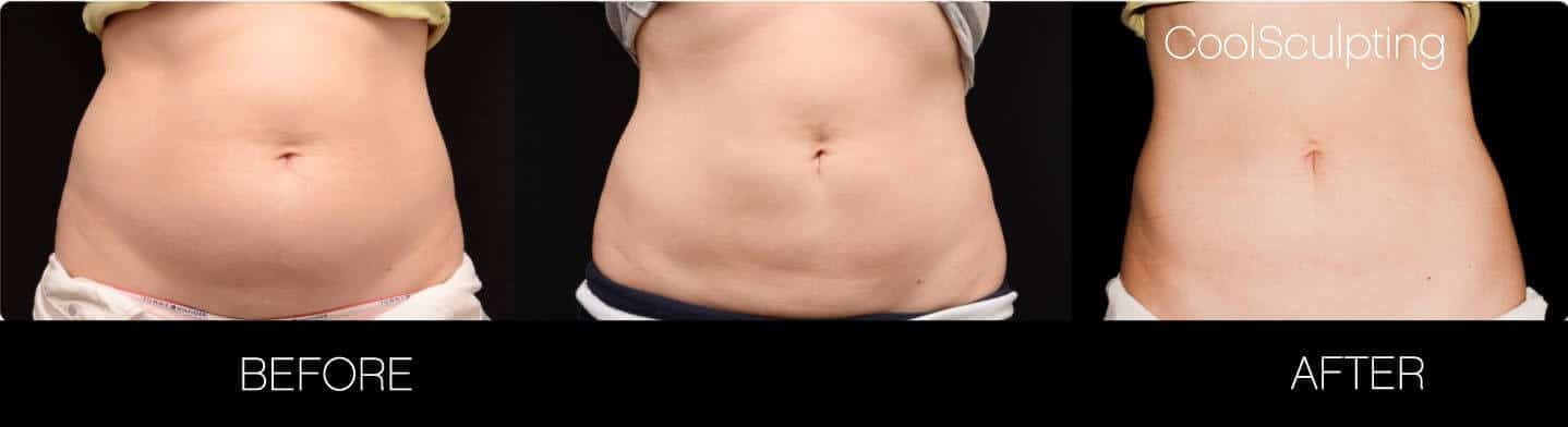 CoolSculpting - Before and After Gallery – Photo 15