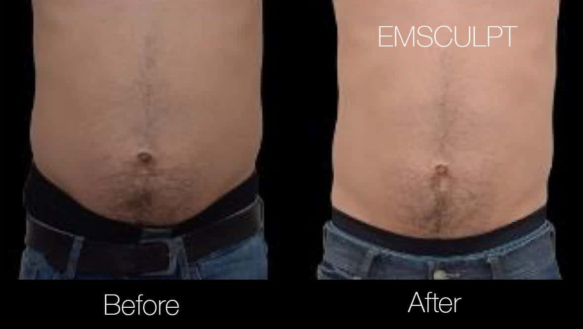 Emsculpt - Before and After Gallery – Photo 15