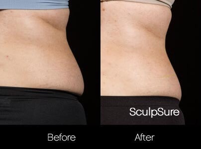 SculpSure - Before and After Gallery – Photo 18