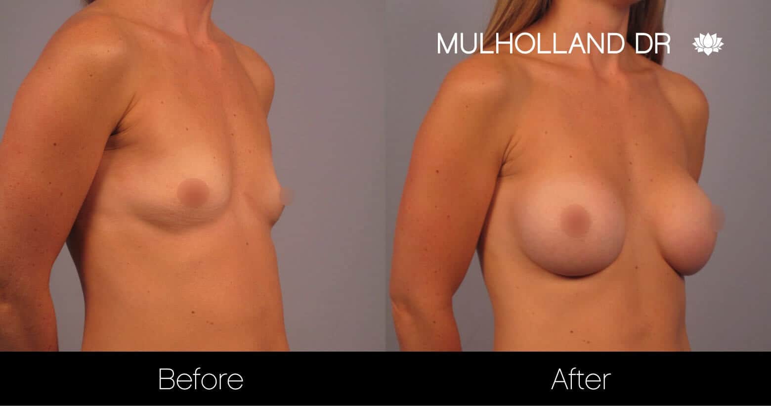 Breast Augmentation - Before and After Gallery – Photo 15
