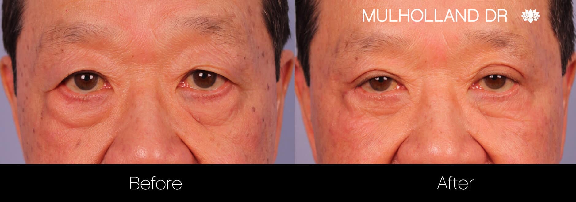 Blepharoplasty - Before and After Gallery – Photo 15