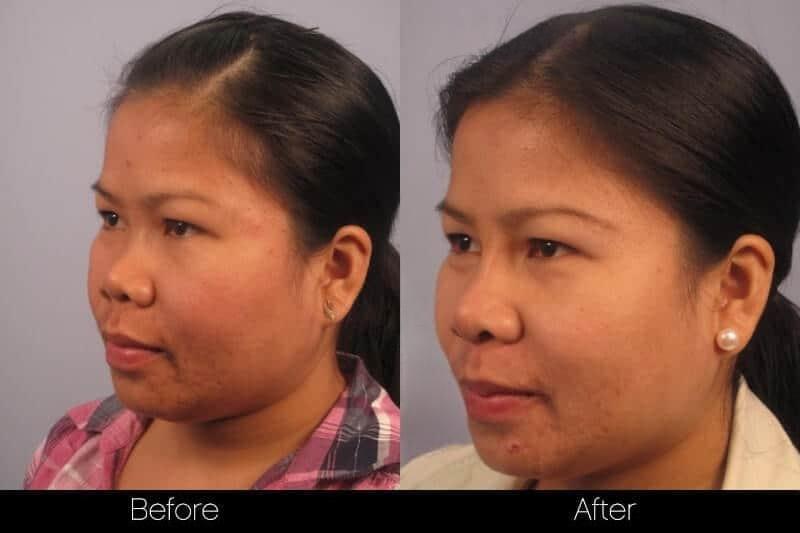 5 Minute Nose Job - Before and After Gallery – Photo 16