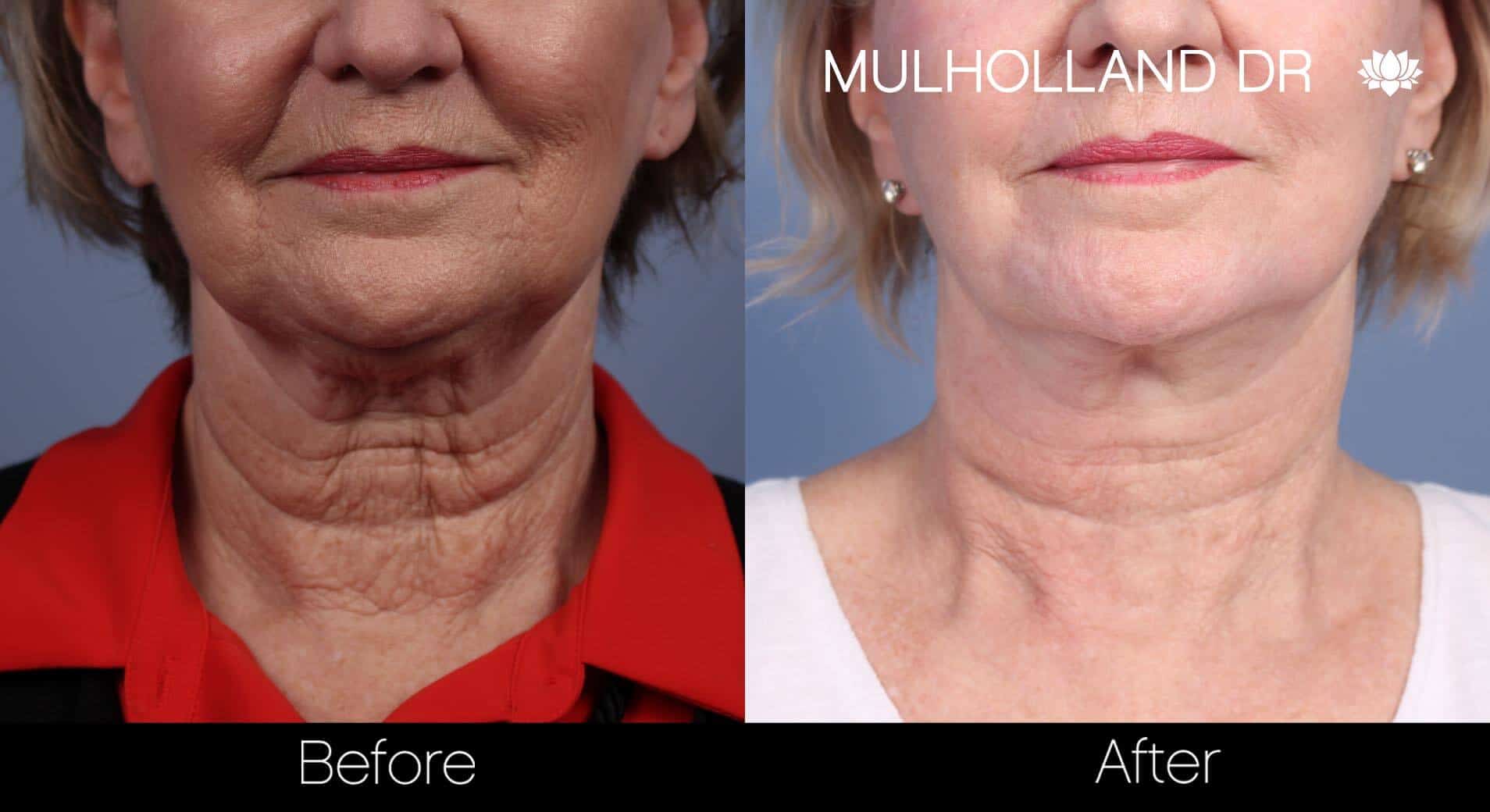 Non-Surgical Facelift Toronto - See Our Before & Afters!