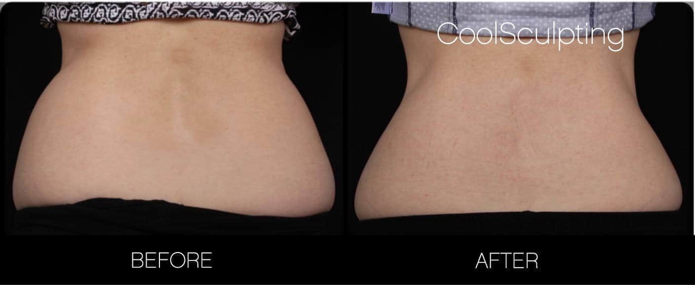 CoolSculpting - Before and After Gallery – Photo 16