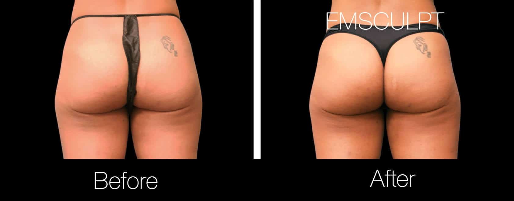 Emsculpt - Before and After Gallery – Photo 16