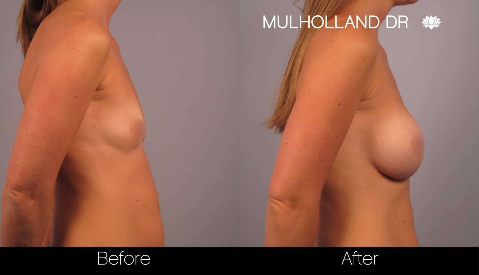 Breast Augmentation - Before and After Gallery – Photo 16