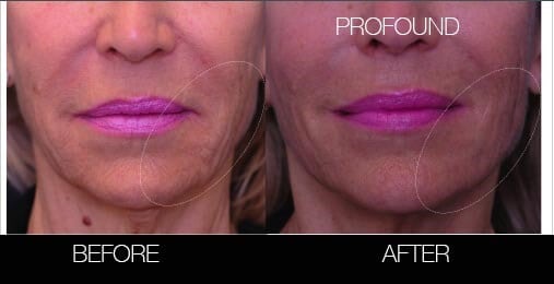 Non-Surgical Facelift - Before and After Gallery – Photo 17