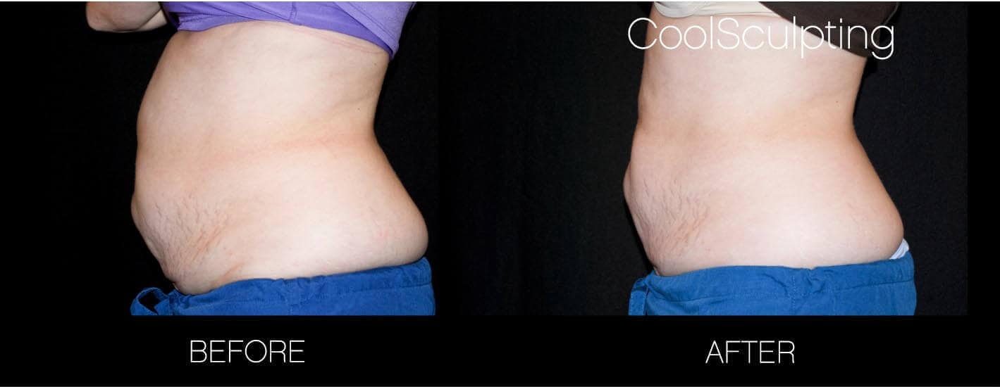 CoolSculpting - Before and After Gallery – Photo 17