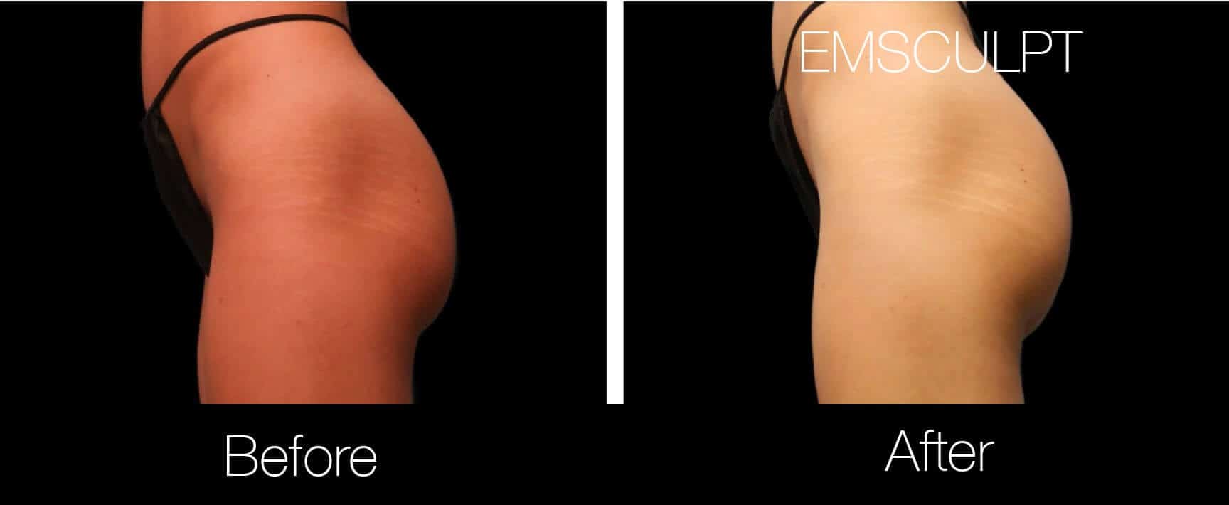 Emsculpt - Before and After Gallery – Photo 17