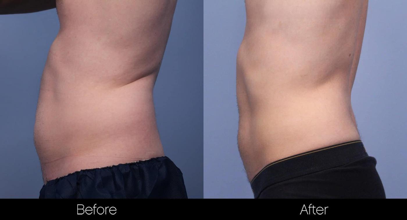 SculpSure - Before and After Gallery – Photo 16