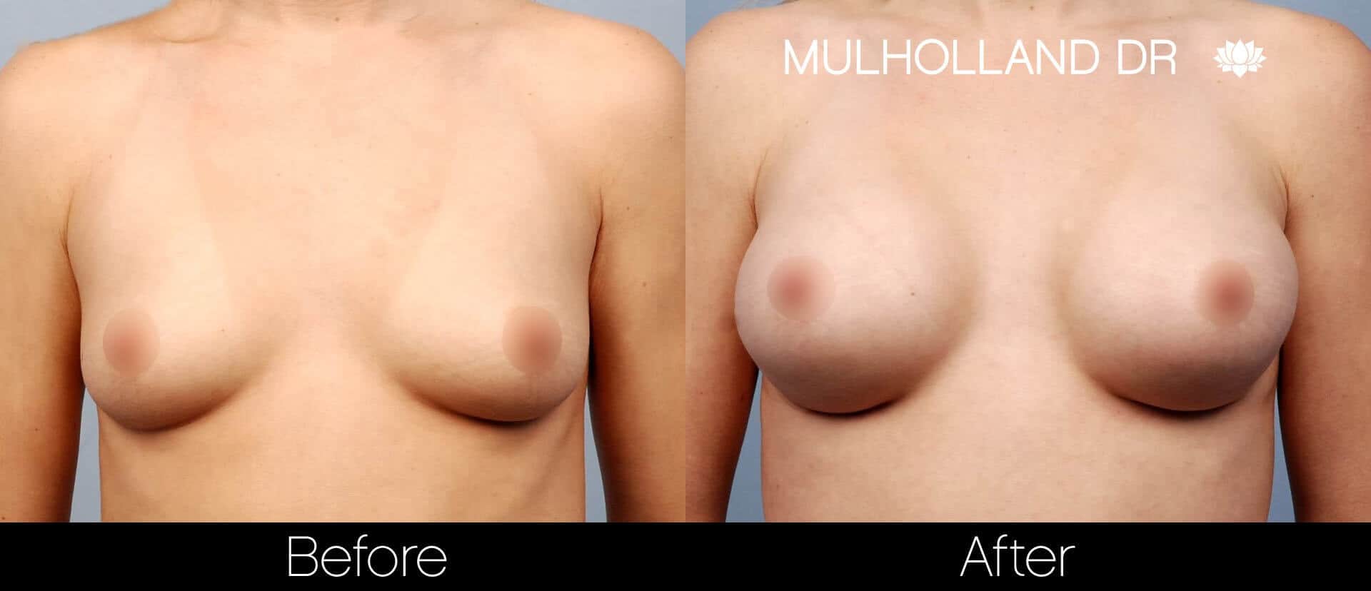 Breast Augmentation - Before and After Gallery – Photo 17