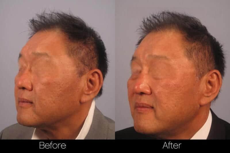 5 Minute Nose Job - Before and After Gallery – Photo 18