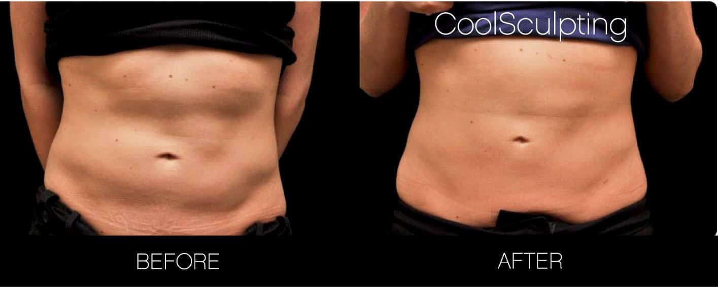 CoolSculpting - Before and After Gallery – Photo 18