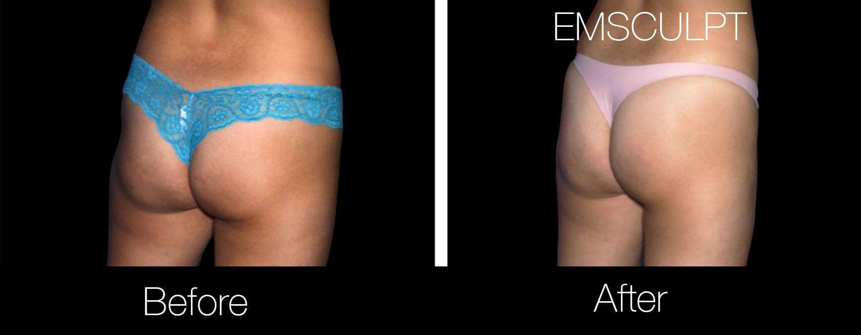 Emsculpt - Before and After Gallery – Photo 19
