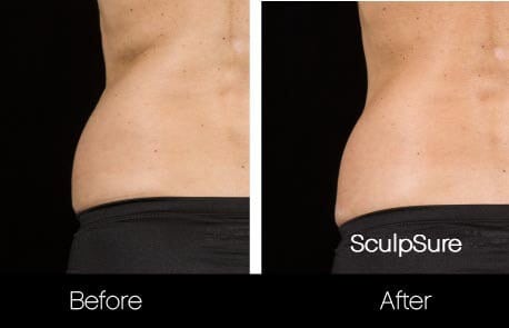 SculpSure - Before and After Gallery – Photo 19