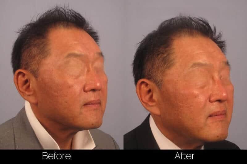 5 Minute Nose Job - Before and After Gallery – Photo 19