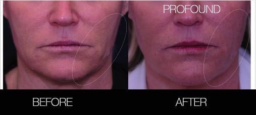 Non-Surgical Facelift - Before and After Gallery – Photo 20