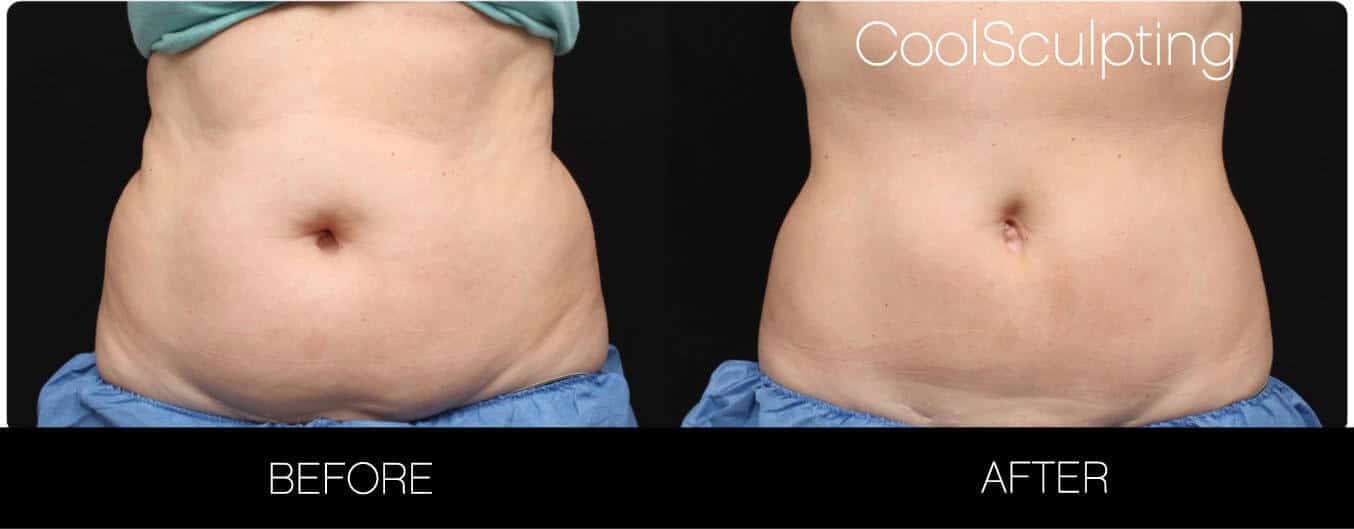 CoolSculpting - Before and After Gallery – Photo 19