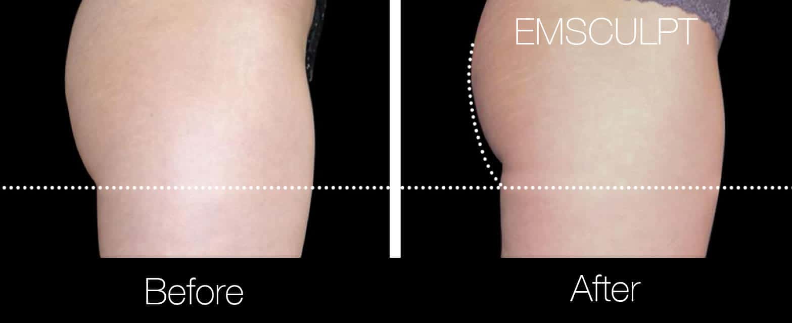 Emsculpt - Before and After Gallery – Photo 20