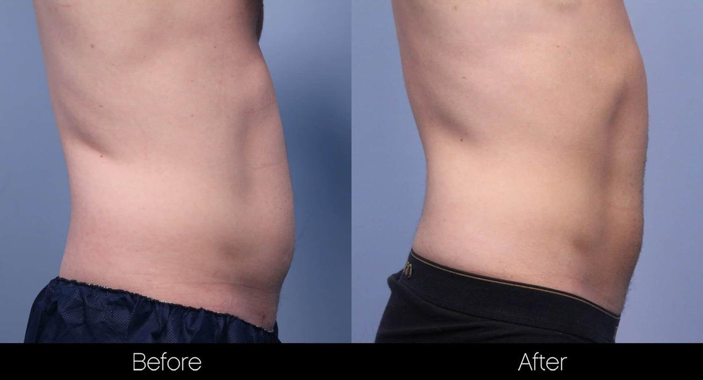 SculpSure - Before and After Gallery – Photo 17