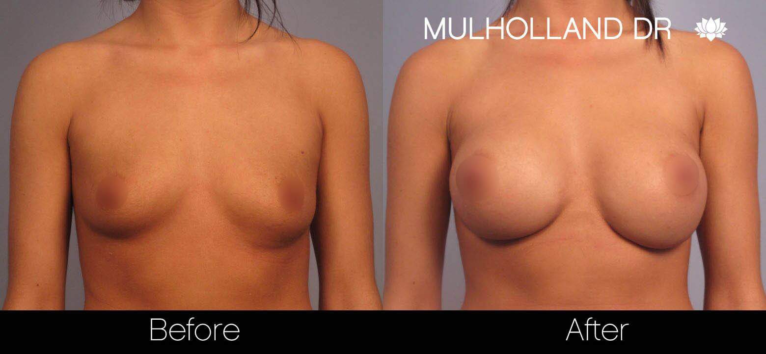 Breast Augmentation - Before and After Gallery – Photo 1