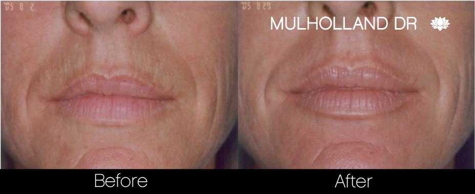 Botox Before and After Gallery - Photo 21