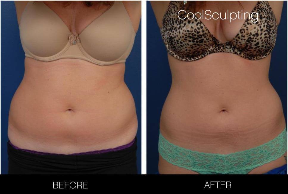 CoolSculpting - Before and After Gallery – Photo 20