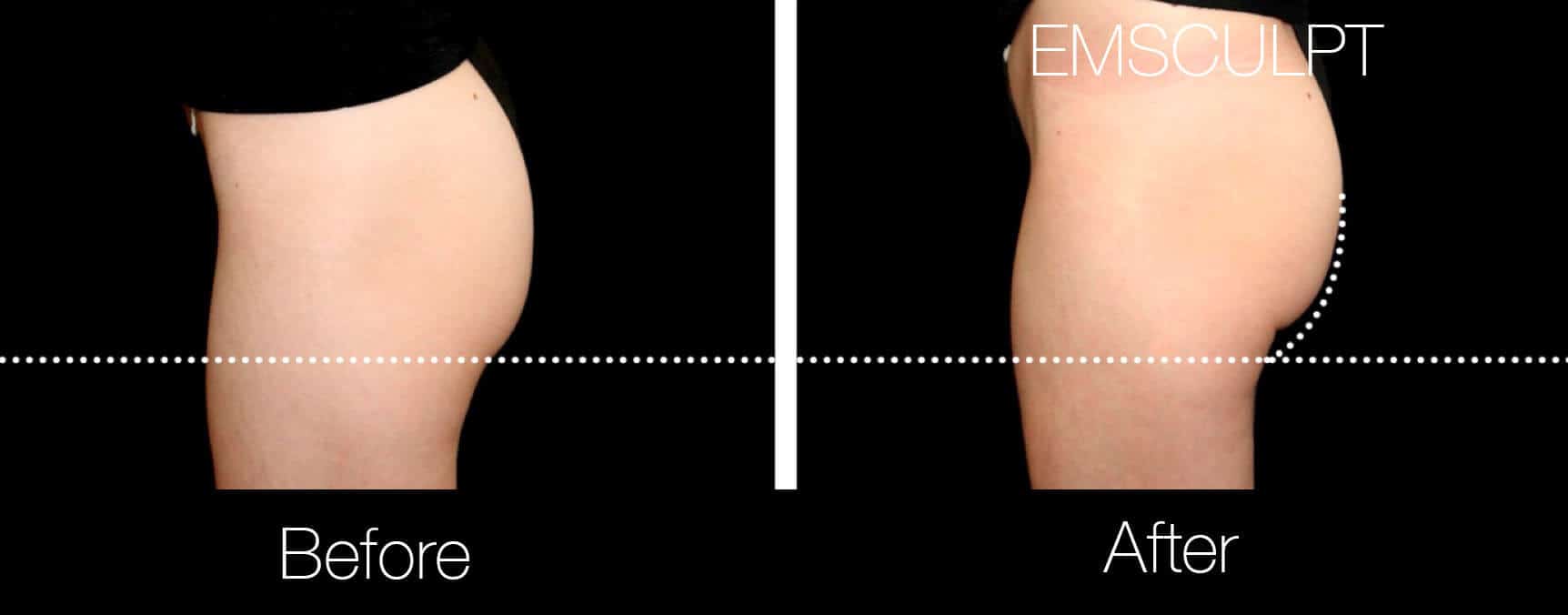Emsculpt - Before and After Gallery – Photo 21