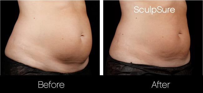 SculpSure - Before and After Gallery – Photo 22