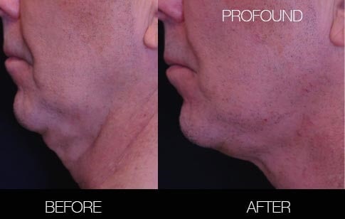 Non-Surgical Facelift - Before and After Gallery – Photo 22