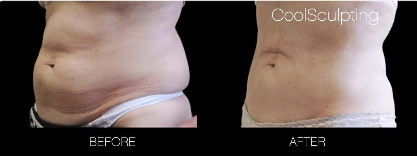 CoolSculpting - Before and After Gallery – Photo 21