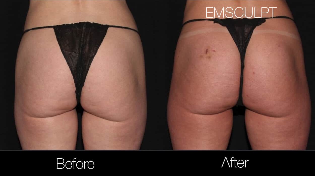 Emsculpt - Before and After Gallery – Photo 22