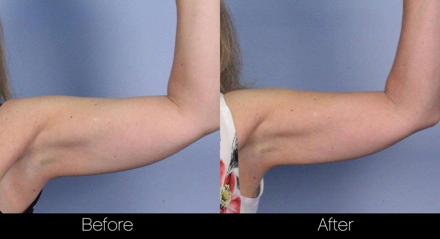 SculpSure - Before and After Gallery – Photo 21