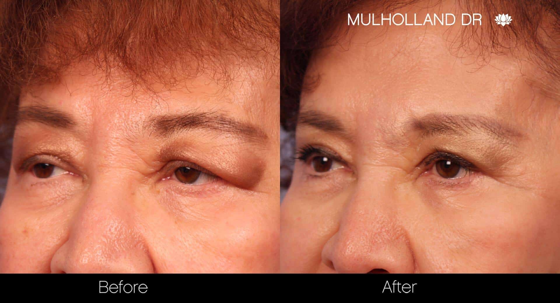 Blepharoplasty - Before and After Gallery – Photo 21