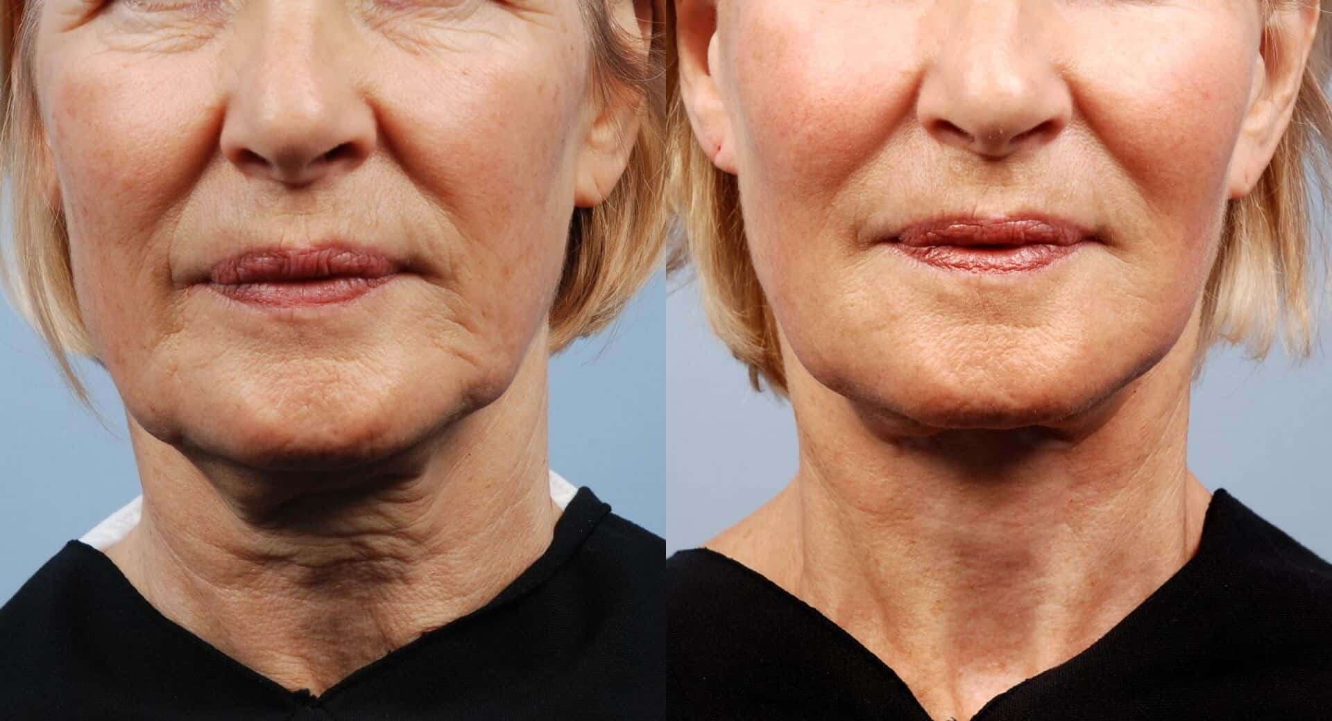 Non-Surgical Facelift - Before and After Gallery – Photo 23