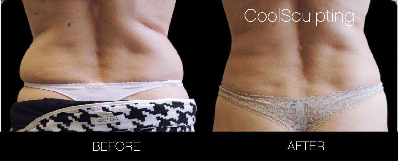 CoolSculpting - Before and After Gallery – Photo 22