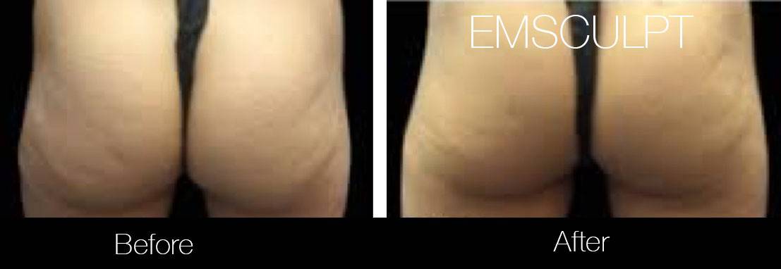 Emsculpt - Before and After Gallery – Photo 23